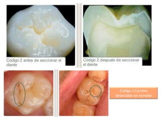 Código 2:Cambio
detectable en esmalte

 