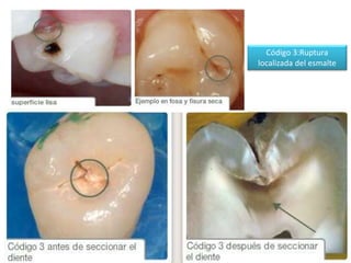 Código 3:Ruptura
localizada del esmalte

 