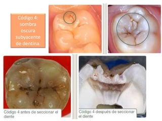 Código 4:
sombra
oscura
subyacente
de dentina.

 