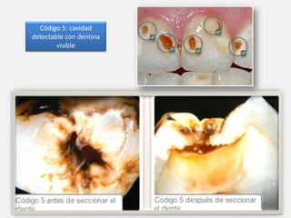 Código 5: cavidad
detectable con dentina
visible

 