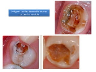 Código 6: cavidad detectable extensa
con dentina sensible.

 