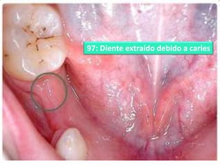 97: Diente extraído debido a caries

 