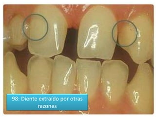 98: Diente extraído por otras
razones

 