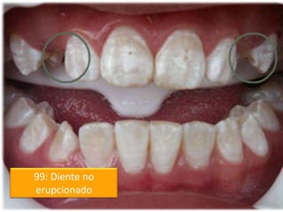 99: Diente no
erupcionado

 