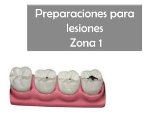 Preparaciones para
lesiones
Zona 1

 