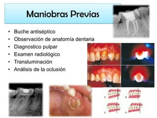 Maniobras Previas
•
•
•
•
•
•

Buche antiséptico
Observación de anatomía dentaria
Diagnostico pulpar
Examen radiológico
Transluminación
Análisis de la oclusión

 