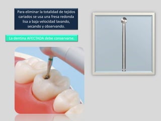 Para eliminar la totalidad de tejidos
cariados se usa una fresa redonda
lisa a baja velocidad lavando,
secando y observando.
La dentina AFECTADA debe conservarse.

 