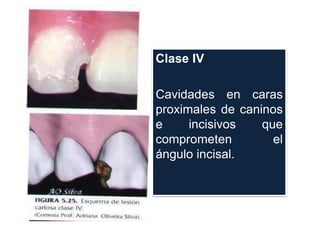 Clase IV
Cavidades en caras
proximales de caninos
e
incisivos
que
comprometen
el
ángulo incisal.

 