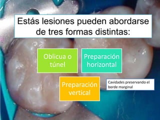 Estás lesiones pueden abordarse
de tres formas distintas:
Oblicua o
túnel

Preparación
horizontal

Preparación
vertical

Cavidades preservando el
borde marginal

 