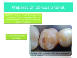 Preparación oblicua o túnel:
OBJETIVO: conservar el reborde marginal pero
solo si la lesión es de mínima extensión y si
está como mínimo a 2.5 mm hacia apical del
reborde marginal

Indicaciones específicas
y limitadas

 