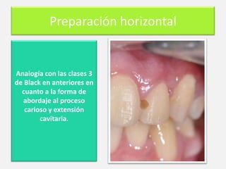 Preparación horizontal

Analogía con las clases 3
de Black en anteriores en
cuanto a la forma de
abordaje al proceso
carioso y extensión
cavitaria.

 