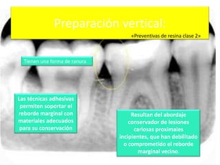 Preparación vertical:
«Preventivas de resina clase 2»

Tienen una forma de ranura

Las técnicas adhesivas
permiten soportar el
reborde marginal con
materiales adecuados
para su conservación

Resultan del abordaje
conservador de lesiones
cariosas proximales
incipientes, que han debilitado
o comprometido el reborde
marginal vecino.

 