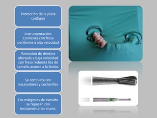 Protección de la pieza
contigua

Instrumentación:
Comienza con fresa
periforme a alta velocidad
Remoción de dentina
afectada a baja velocidad
con fresa redonda lisa de
tamaño acorde a la lesión.
Se completa con
excavadores y cucharillas

Los márgenes de esmalte
se repasan con
instrumental de mano.

 