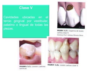 Clase V
Cavidades ubicadas en el
tercio gingival por vestibular,
palatino o lingual de todas las
piezas.

 