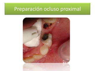 Preparación ocluso proximal

 