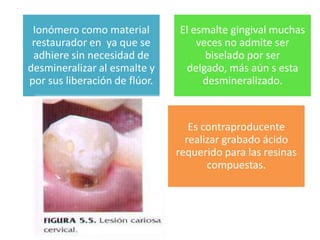 Ionómero como material
restaurador en ya que se
adhiere sin necesidad de
desmineralizar al esmalte y
por sus liberación de flúor.

El esmalte gingival muchas
veces no admite ser
biselado por ser
delgado, más aún s esta
desmineralizado.

Es contraproducente
realizar grabado ácido
requerido para las resinas
compuestas.

 