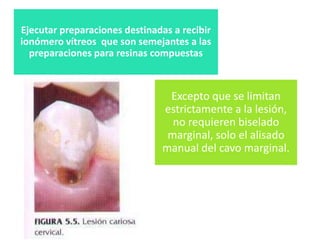 Ejecutar preparaciones destinadas a recibir
ionómero vítreos que son semejantes a las
preparaciones para resinas compuestas

Excepto que se limitan
estrictamente a la lesión,
no requieren biselado
marginal, solo el alisado
manual del cavo marginal.

 