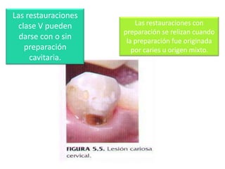 Las restauraciones
clase V pueden
darse con o sin
preparación
cavitaria.

Las restauraciones con
preparación se relizan cuando
la preparación fue originada
por caries u origen mixto.

 