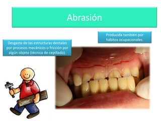 Abrasión
Desgaste de las estructuras dentales
por procesos mecánicos o fricción por
algún objeto (técnica de cepillado).

Producida también por
hábitos ocupacionales.

 