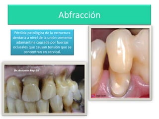 Abfracción
Pérdida patológica de la estructura
dentaria a nivel de la unión cemento
adamantina causada por fuerzas
oclusales que causan tensión que se
concentran en cervical.

 