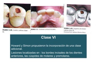 Clase VI
Howard y Simon propusieron la incorporación de una clase
adicional.
Lesiones localizadas en : los bordes incisales de los dientes
anteriores, las cúspides de molares y premolares.

 