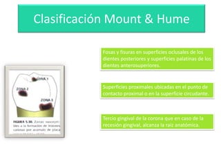 Clasificación Mount & Hume
Fosas y fisuras en superficies oclusales de los
dientes posteriores y superficies palatinas de los
dientes anterosuperiores.

Superficies proximales ubicadas en el punto de
contacto proximal o en la superficie circudante.

Tercio gingival de la corona que en caso de la
recesión gingival, alcanza la raíz anatómica.

 
