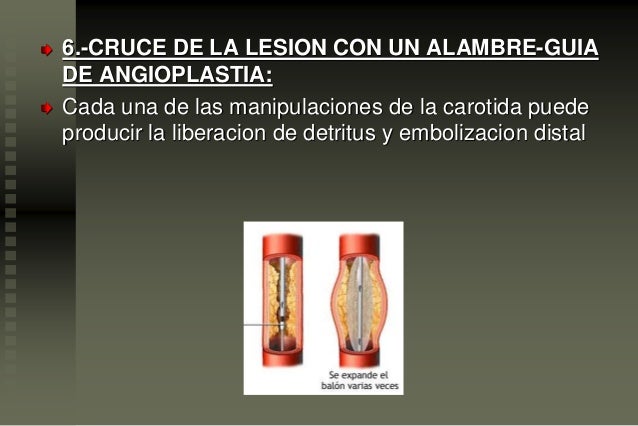 De que pasa varikoz de las venas