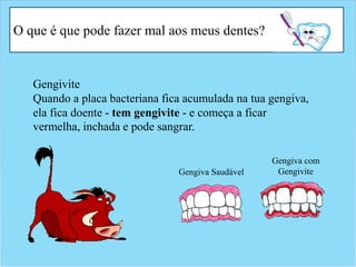 O que é que pode fazer mal aos meus dentes?
Gengivite
Quando a placa bacteriana fica acumulada na tua gengiva,
ela fica doente - tem gengivite - e começa a ficar
vermelha, inchada e pode sangrar.
Gengiva Saudável
Gengiva com
Gengivite
 