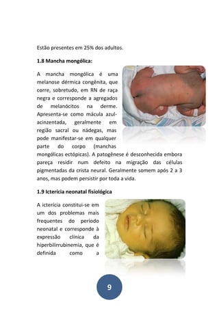 9
Estão presentes em 25% dos adultos.
1.8 Mancha mongólica:
A mancha mongólica é uma
melanose dérmica congênita, que
corre, sobretudo, em RN de raça
negra e corresponde a agregados
de melanócitos na derme.
Apresenta-se como mácula azul-
acinzentada, geralmente em
região sacral ou nádegas, mas
pode manifestar-se em qualquer
parte do corpo (manchas
mongólicas ectópicas). A patogênese é desconhecida embora
pareça residir num defeito na migração das células
pigmentadas da crista neural. Geralmente somem após 2 a 3
anos, mas podem persistir por toda a vida.
1.9 Icterícia neonatal fisiológica
A icterícia constitui-se em
um dos problemas mais
frequentes do período
neonatal e corresponde à
expressão clínica da
hiperbilirrubinemia, que é
definida como a
 