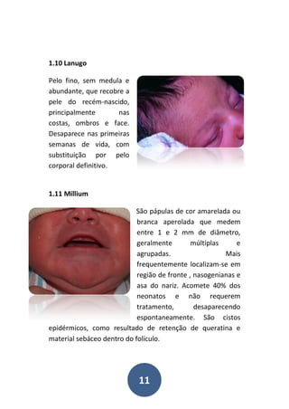 11
1.10 Lanugo
Pelo fino, sem medula e
abundante, que recobre a
pele do recém-nascido,
principalmente nas
costas, ombros e face.
Desaparece nas primeiras
semanas de vida, com
substituição por pelo
corporal definitivo.
1.11 Millium
São pápulas de cor amarelada ou
branca aperolada que medem
entre 1 e 2 mm de diâmetro,
geralmente múltiplas e
agrupadas. Mais
frequentemente localizam-se em
região de fronte , nasogenianas e
asa do nariz. Acomete 40% dos
neonatos e não requerem
tratamento, desaparecendo
espontaneamente. São cistos
epidérmicos, como resultado de retenção de queratina e
material sebáceo dentro do folículo.
 