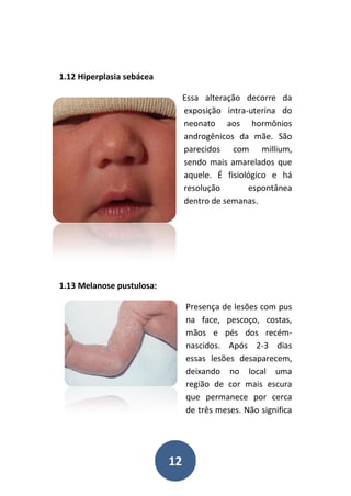 12
1.12 Hiperplasia sebácea
Essa alteração decorre da
exposição intra-uterina do
neonato aos hormônios
androgênicos da mãe. São
parecidos com millium,
sendo mais amarelados que
aquele. É fisiológico e há
resolução espontânea
dentro de semanas.
1.13 Melanose pustulosa:
Presença de lesões com pus
na face, pescoço, costas,
mãos e pés dos recém-
nascidos. Após 2-3 dias
essas lesões desaparecem,
deixando no local uma
região de cor mais escura
que permanece por cerca
de três meses. Não significa
 