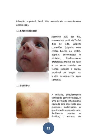 13
infecção da pele do bebê. Não necessita de tratamento com
antibióticos.
1.14 Acne neonatal
Acomete 20% dos RN,
ocorrendo a partir de 7 a 14
dias de vida. Surgem
comedões (pápulas com
centro branco ou preto),
pápulas eritematosas e
pústulas, localizando-se
preferencialmente na face
e por vezes também no
tronco superior e região
proximal dos braços. As
lesões desaparecem após
semanas.
1.15 Miliária
A miliária, popularmente
conhecida como brotoeja, é
uma dermatite inflamatória
causada pela obstrução das
glândulas sudoríparas, o
que impede a saída do suor.
Ambientes quentes e
úmidos, o excesso de
 