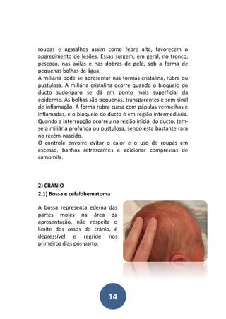 14
roupas e agasalhos assim como febre alta, favorecem o
aparecimento de lesões. Essas surgem, em geral, no tronco,
pescoço, nas axilas e nas dobras de pele, sob a forma de
pequenas bolhas de água.
A miliária pode se apresentar nas formas cristalina, rubra ou
pustulosa. A miliária cristalina ocorre quando o bloqueio do
ducto sudoríparo se dá em ponto mais superficial da
epiderme. As bolhas são pequenas, transparentes e sem sinal
de inflamação. A forma rubra cursa com pápulas vermelhas e
inflamadas, e o bloqueio do ducto é em região intermediária.
Quando a interrupção ocorreu na região inicial do ducto, tem-
se a miliária profunda ou pustulosa, sendo esta bastante rara
no recém-nascido.
O controle envolve evitar o calor e o uso de roupas em
excesso, banhos refrescantes e adicionar compressas de
camomila.
2) CRANIO
2.1) Bossa e cefalohematoma
A bossa representa edema das
partes moles na área da
apresentação, não respeita o
limite dos ossos do crânio, é
depressível e regride nos
primeiros dias pós-parto.
 