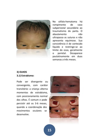 15
No céfalo-hematoma há
rompimento de vaso
subperiostal secundário ao
traumatismo do parto. O
abaulamento não
ultrapassa as suturas e não
apresenta equimose. Sua
consistência é de conteúdo
líquido e restringe-se ao
limite do osso, geralmente
o parietal. Desaparece
paulatinamente em duas
semanas a três meses.
3) OLHOS
3.1) Estrabismo:
Pode ser divergente ou
convergente, com caráter
transitório: a criança alterna
momentos de estrabismo,
com posicionamento normal
dos olhos. É comum e pode
persistir até os 3-6 meses,
quando a coordenação dos
movimentos oculares se
desenvolve.
 