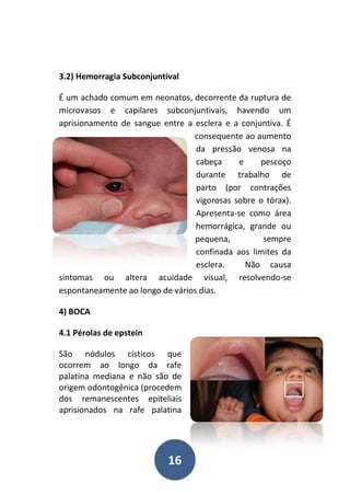16
3.2) Hemorragia Subconjuntival
É um achado comum em neonatos, decorrente da ruptura de
microvasos e capilares subconjuntivais, havendo um
aprisionamento de sangue entre a esclera e a conjuntiva. É
consequente ao aumento
da pressão venosa na
cabeça e pescoço
durante trabalho de
parto (por contrações
vigorosas sobre o tórax).
Apresenta-se como área
hemorrágica, grande ou
pequena, sempre
confinada aos limites da
esclera. Não causa
sintomas ou altera acuidade visual, resolvendo-se
espontaneamente ao longo de vários dias.
4) BOCA
4.1 Pérolas de epstein
São nódulos císticos que
ocorrem ao longo da rafe
palatina mediana e não são de
origem odontogênica (procedem
dos remanescentes epiteliais
aprisionados na rafe palatina
 