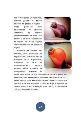 22
não-comunicante. Em neonatos,
ocorrem geralmente devido
patência do processo vaginal –
tecido peritoneal que
descendende da cavidade
abdominal ao escroto
juntamente com o testículo – ou
devido a absorção inadequada
do líquido na túnica vaginal
após o fechamento do processo
vaginal.
O aumento de volume não
doloroso, com dificuldade de
palpação dos testículos são os
principais sinais diagnósticos,
associados ao teste da
transluminescência escrotal
positivo (vê-se aumento da
transparência testicular ao
incidir uma fonte de luz diretamente sobre a pele). Em
recém-nascidos a maioria das hidroceles desaparece até os 12
meses de vida, após fechamento espontâneo da comunicação
anormal. Caso não seja esse o caso, ou haja progressão do
volume escrotal ou associação com hérnia, o tratamento
cirúrgico deve ser instituído.
 
