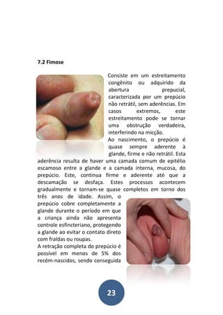 23
7.2 Fimose
Consiste em um estreitamento
congênito ou adquirido da
abertura prepucial,
caracterizada por um prepúcio
não retrátil, sem aderências. Em
casos extremos, este
estreitamento pode se tornar
uma obstrução verdadeira,
interferindo na micção.
Ao nascimento, o prepúcio é
quase sempre aderente à
glande, firme e não retrátil. Esta
aderência resulta de haver uma camada comum de epitélio
escamoso entre a glande e a camada interna, mucosa, do
prepúcio. Este, continua firme e aderente até que a
descamação se desfaça. Estes processos acontecem
gradualmente e tornam-se quase completos em torno dos
três anos de idade. Assim, o
prepúcio cobre completamente a
glande durante o período em que
a criança ainda não apresenta
controle esfincteriano, protegendo
a glande ao evitar o contato direto
com fraldas ou roupas.
A retração completa do prepúcio é
possível em menos de 5% dos
recém-nascidos, sendo conseguida
 