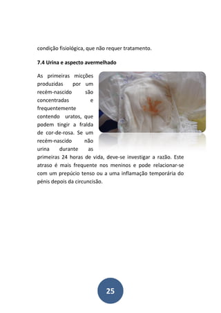 25
condição fisiológica, que não requer tratamento.
7.4 Urina e aspecto avermelhado
As primeiras micções
produzidas por um
recém-nascido são
concentradas e
frequentemente
contendo uratos, que
podem tingir a fralda
de cor-de-rosa. Se um
recém-nascido não
urina durante as
primeiras 24 horas de vida, deve-se investigar a razão. Este
atraso é mais frequente nos meninos e pode relacionar-se
com um prepúcio tenso ou a uma inflamação temporária do
pénis depois da circuncisão.
 