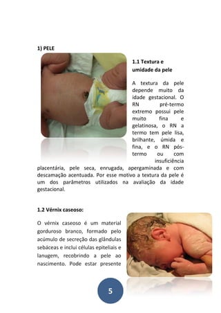 5
1) PELE
1.1 Textura e
umidade da pele
A textura da pele
depende muito da
idade gestacional. O
RN pré-termo
extremo possui pele
muito fina e
gelatinosa, o RN a
termo tem pele lisa,
brilhante, úmida e
fina, e o RN pós-
termo ou com
insuficiência
placentária, pele seca, enrugada, apergaminada e com
descamação acentuada. Por esse motivo a textura da pele é
um dos parâmetros utilizados na avaliação da idade
gestacional.
1.2 Vérnix caseoso:
O vérnix caseoso é um material
gorduroso branco, formado pelo
acúmulo de secreção das glândulas
sebáceas e inclui células epiteliais e
lanugem, recobrindo a pele ao
nascimento. Pode estar presente
 