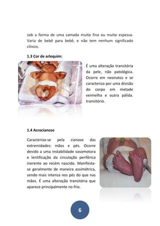 6
sob a forma de uma camada muito fina ou muito espessa.
Varia de bebê para bebê, e não tem nenhum significado
clínico.
1.3 Cor de arlequim:
É uma alteração transitória
da pele, não patológica.
Ocorre em neonatos e se
caracteriza por uma divisão
do corpo em metade
vermelha e outra pálida.
transitório.
1.4 Acrocianose
Caracteriza-se pela cianose das
extremidades: mãos e pés. Ocorre
devido a uma instabilidade vasomotora
e lentificação da circulação periférica
inerente ao recém nascido. Manifesta-
se geralmente de maneira assimétrica,
sendo mais intensa nos pés do que nas
mãos. É uma alteração transitória que
aparece principalmente no frio.
 