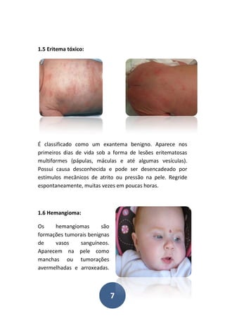 7
1.5 Eritema tóxico:
É classificado como um exantema benigno. Aparece nos
primeiros dias de vida sob a forma de lesões eritematosas
multiformes (pápulas, máculas e até algumas vesículas).
Possui causa desconhecida e pode ser desencadeado por
estímulos mecânicos de atrito ou pressão na pele. Regride
espontaneamente, muitas vezes em poucas horas.
1.6 Hemangioma:
Os hemangiomas são
formações tumorais benignas
de vasos sanguíneos.
Aparecem na pele como
manchas ou tumorações
avermelhadas e arroxeadas.
 