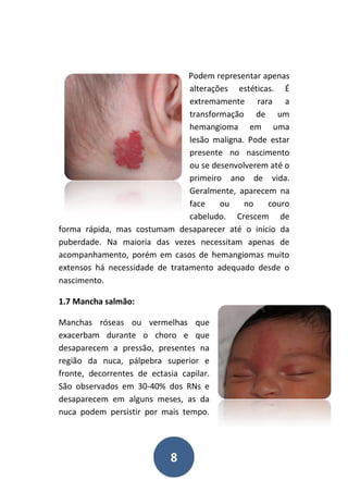 8
Podem representar apenas
alterações estéticas. É
extremamente rara a
transformação de um
hemangioma em uma
lesão maligna. Pode estar
presente no nascimento
ou se desenvolverem até o
primeiro ano de vida.
Geralmente, aparecem na
face ou no couro
cabeludo. Crescem de
forma rápida, mas costumam desaparecer até o início da
puberdade. Na maioria das vezes necessitam apenas de
acompanhamento, porém em casos de hemangiomas muito
extensos há necessidade de tratamento adequado desde o
nascimento.
1.7 Mancha salmão:
Manchas róseas ou vermelhas que
exacerbam durante o choro e que
desaparecem a pressão, presentes na
região da nuca, pálpebra superior e
fronte, decorrentes de ectasia capilar.
São observados em 30-40% dos RNs e
desaparecem em alguns meses, as da
nuca podem persistir por mais tempo.
 