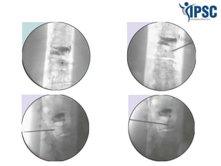 Interventional approach to back pain Management | PPT