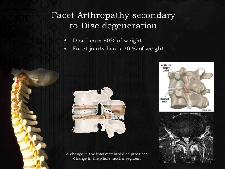 Interventional approach to back pain dr surange