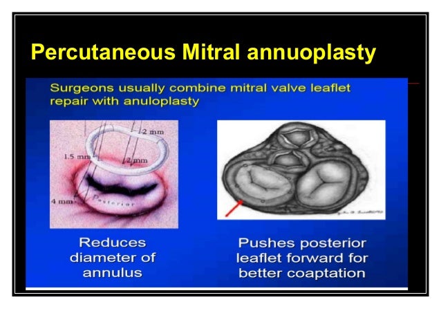 mitral valve replacement mitral valve replacement