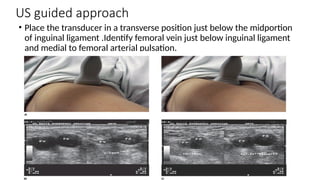 US guided approach
• Place the transducer in a transverse position just below the midportion
of inguinal ligament .Identify femoral vein just below inguinal ligament
and medial to femoral arterial pulsation.
 