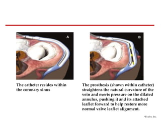 The catheter resides within the coronary sinus The prosthesis (shown within catheter) straightens the natural curvature of the vein and exerts pressure on the dilated annulus, pushing it and its attached leaflet forward to help restore more normal valve leaflet alignment.  *Evalve, Inc. 