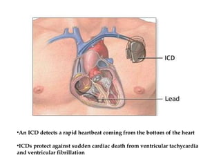 An ICD detects a rapid heartbeat coming from the bottom of the heart ICDs protect against sudden cardiac death from ventricular tachycardia and ventricular fibrillation 