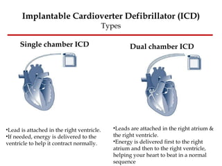 Implantable Cardioverter Defibrillator (ICD) Types Single chamber ICD Lead is attached in the right ventricle.  If needed, energy is delivered to the ventricle to help it contract normally. Dual chamber ICD Leads are attached in the right atrium & the right ventricle.  Energy is delivered first to the right atrium and then to the right ventricle, helping your heart to beat in a normal sequence  