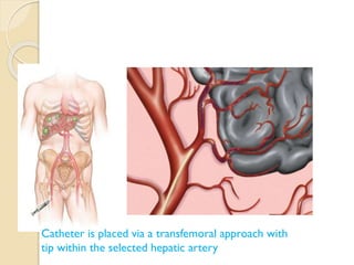 Transhepatic Approach Interventional procedures in hepatobiliary system | PPTX